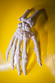 3D printed bone implants