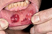 Contusions inside mouth after assault