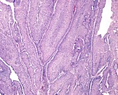 Urinary bladder papilloma, light micrograph