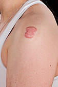 Keloid scarring after chickenpox