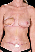 Breast reconstruction surgery scars