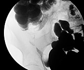 Crohn's disease, X-ray