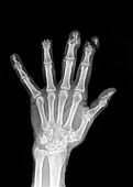 Lawnmower hand injury, X-ray