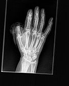 Thumb amputation injury, X-ray