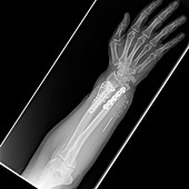 Hand amputation repair, post-operative X-ray