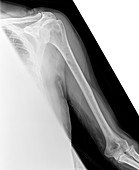 Myeloma bone scan, X-ray