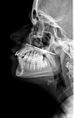 Needle nose injury, X-ray