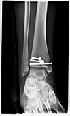 Salter Harris ankle fracture repair, post-operative X-ray