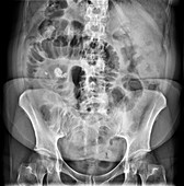 Situs inversus, lower abdominal X-ray
