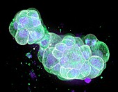 Colon cancer cells, fluorescence micrograph