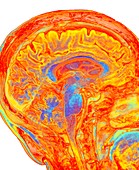 Human brain, sagittal MRI scan