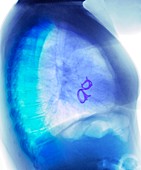 Mitral valve replacement, post-operative X-ray