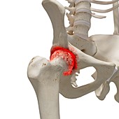 Arthritis in the hip, illustration