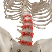Arthritis in the lumbar spine, illustration