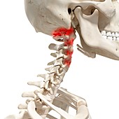 Arthritis in the cervical spine, illustration