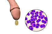 Gonorrhoea infection, illustration
