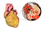 Heart disease, illustration