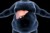 Fatty liver in obese person, conceptual illustration