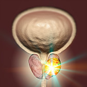 Treatment of prostate cancer, conceptual illustration