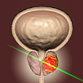 Laserotherapy of prostate cancer, conceptual illustration