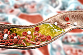 Atheromatous plaque in artery, illustration