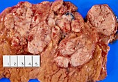 Non-Hodgkin's lymphoma in nodes near pancreas