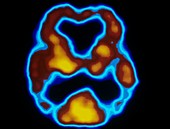 Brain activity in Alzheimer's, SPECT scan