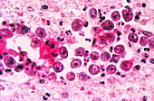 Naegleria fowleri amoeba infection, light micrograph