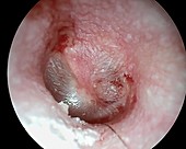 Acute viral otitis, otoscope view