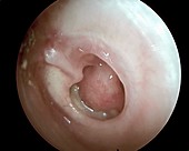 Perforated eardrum in ear infection, otoscope view