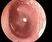 Glue ear and dermoid cyst, otoscope view