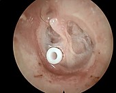 Grommet in the eardrum, otoscope view