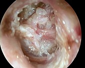 Cholesteatoma of the eardrum, otoscope view