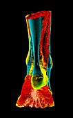 Human foot and Achilles tendon, 3D CT scan