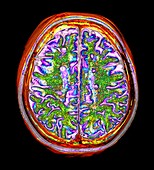 Multiple sclerosis, axial brain MRI scan