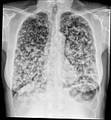 Secondary lung cancers, X-ray