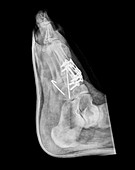 Pinned fractured metatarsal foot bones, X-ray