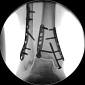 Pinned fractured ankle bones, X-ray