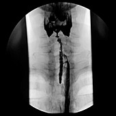 Aspiration during barium swallow examination, X-ray