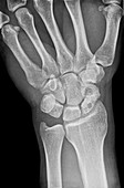 Fractured scaphoid wrist bone, X-ray