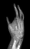 Thumb created from index finger, X-ray