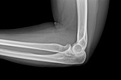 Fracture of elbow bone, X-ray