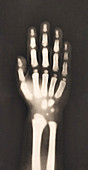 X-ray of a child's hand, 1890s