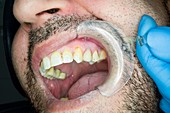 Cosmetic restoration of discoloured premolar