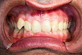 Dental malocclusion