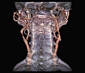 Atherosclerosis in neck arteries, 3D CT scan