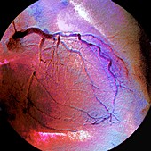 Coronary artery stenosis, coronarography scan