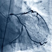 Left coronary artery, coronarography scan