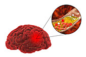 Treatment and prevention of stroke due to atherosclerosis, c