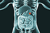 Human stomach cancer, illustration